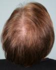 Before Hair Transplant&nbsp;Hair Thinning